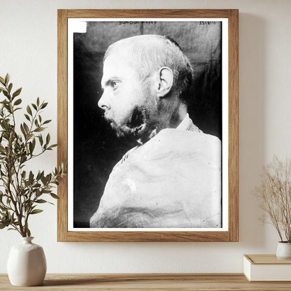 Historic Dum-Dum Wound [man] Print, Vintage Art