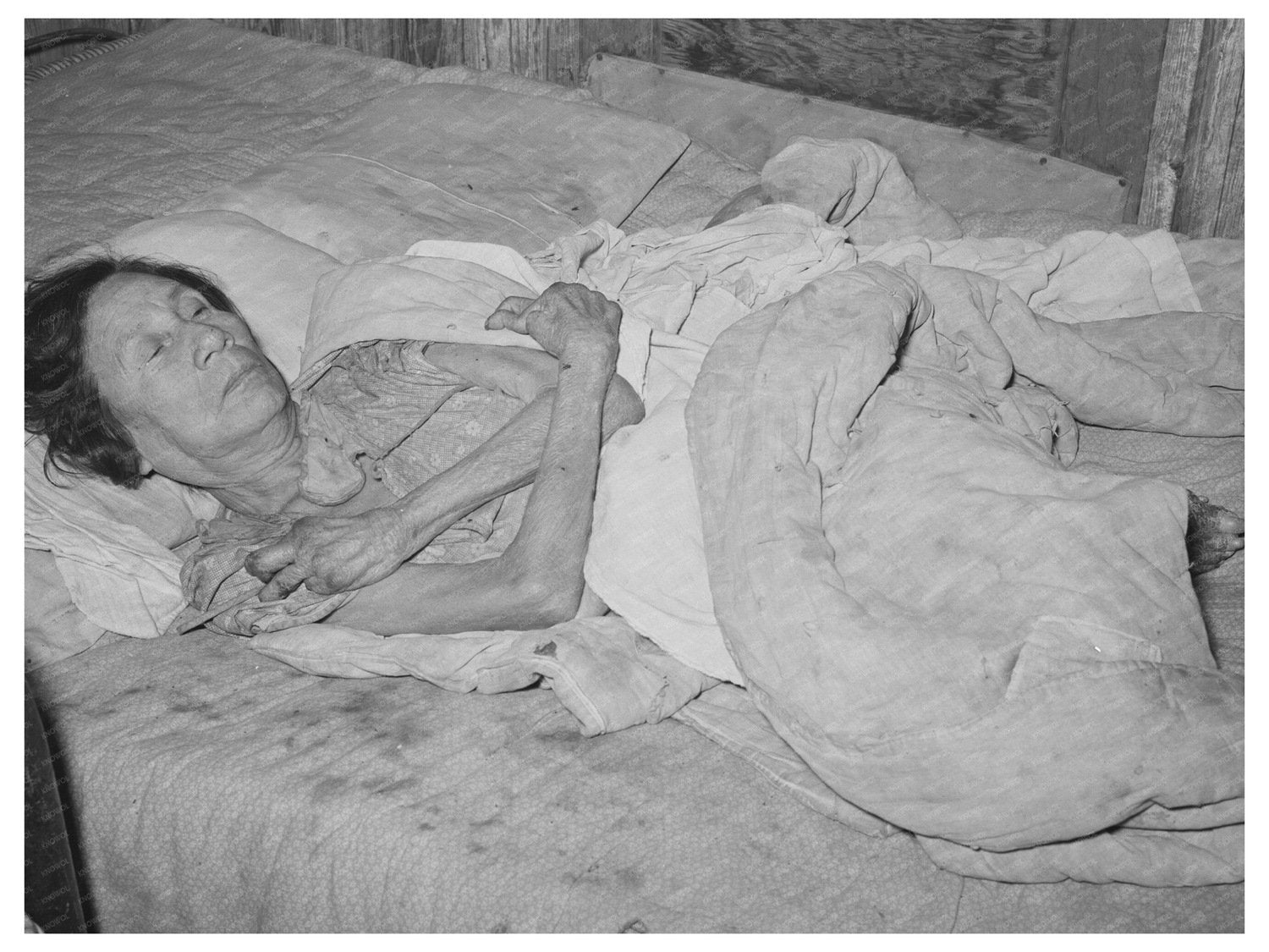 Mexican Woman with Arthritis in Crystal City 1939