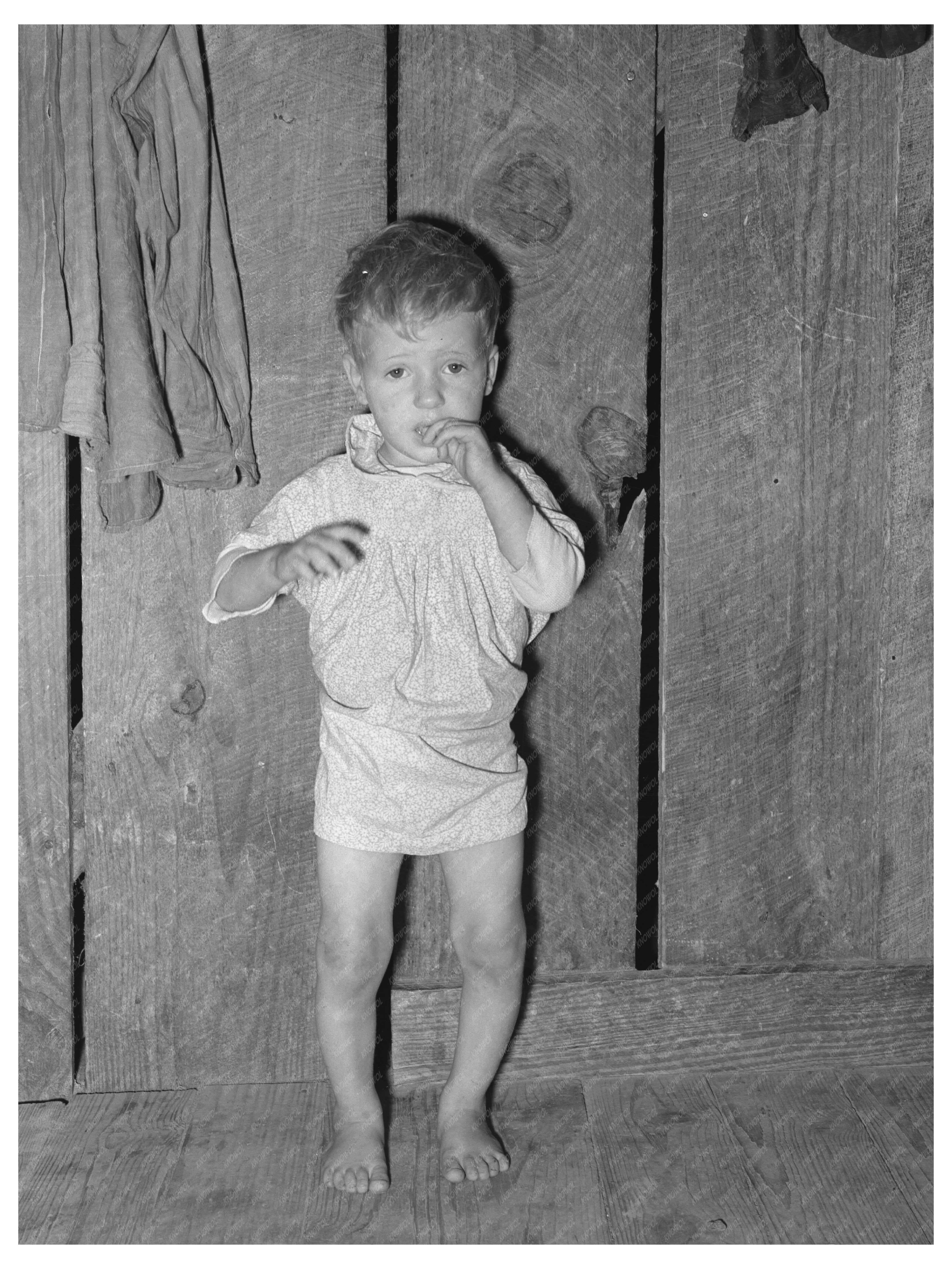 Child with Rickets in Jefferson Texas March 1939